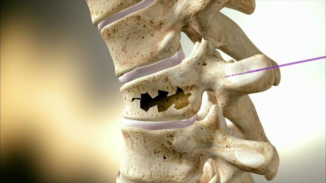 Damaged spine disc disc