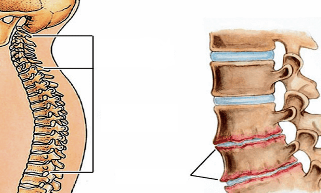 What is osteochondrosis of the spine