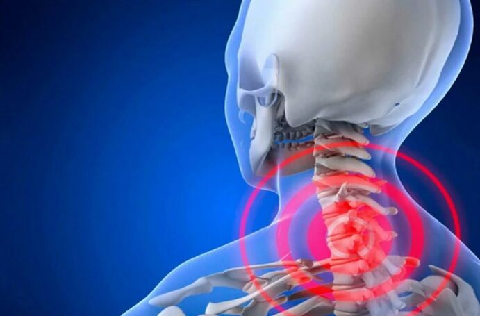 Osteochondrosis of the cervical column