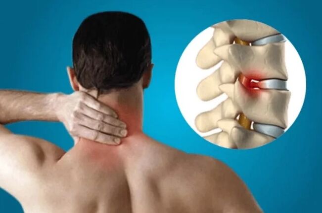 Osteochondrosis of the spine
