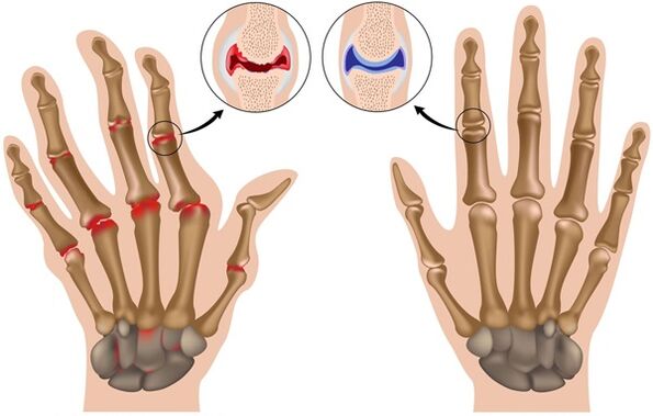 finger deformity due to osteoarthritis