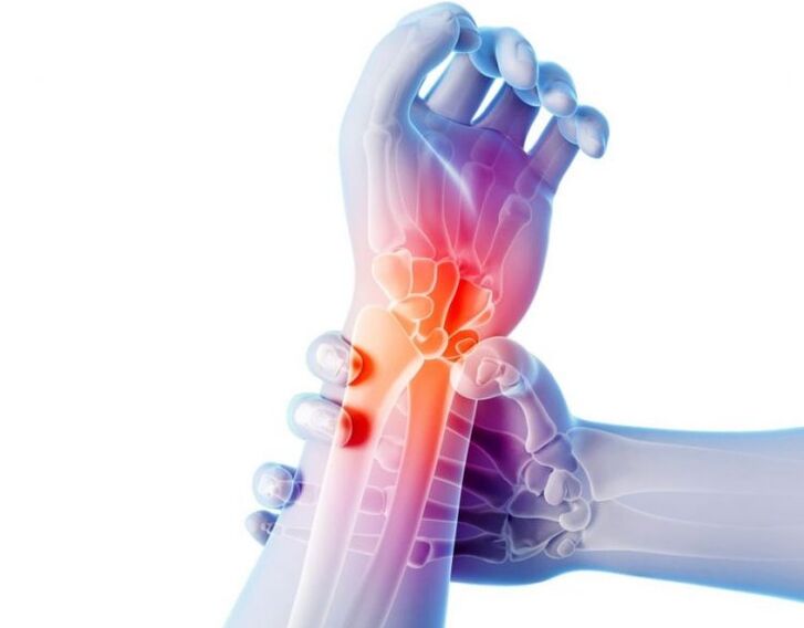 Osteoarthritis of the joints is accompanied by pain and requires complex treatment