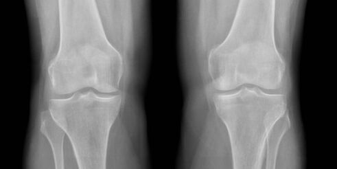 osteoarthritis of the knee on x-ray